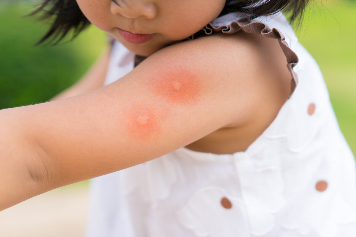 Una niña a la que le ha picado un mosquito.