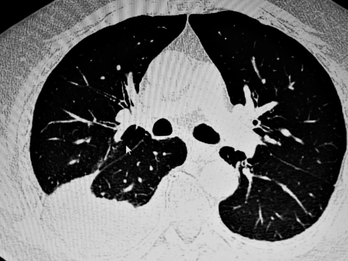 A pleural effusion in a cat.