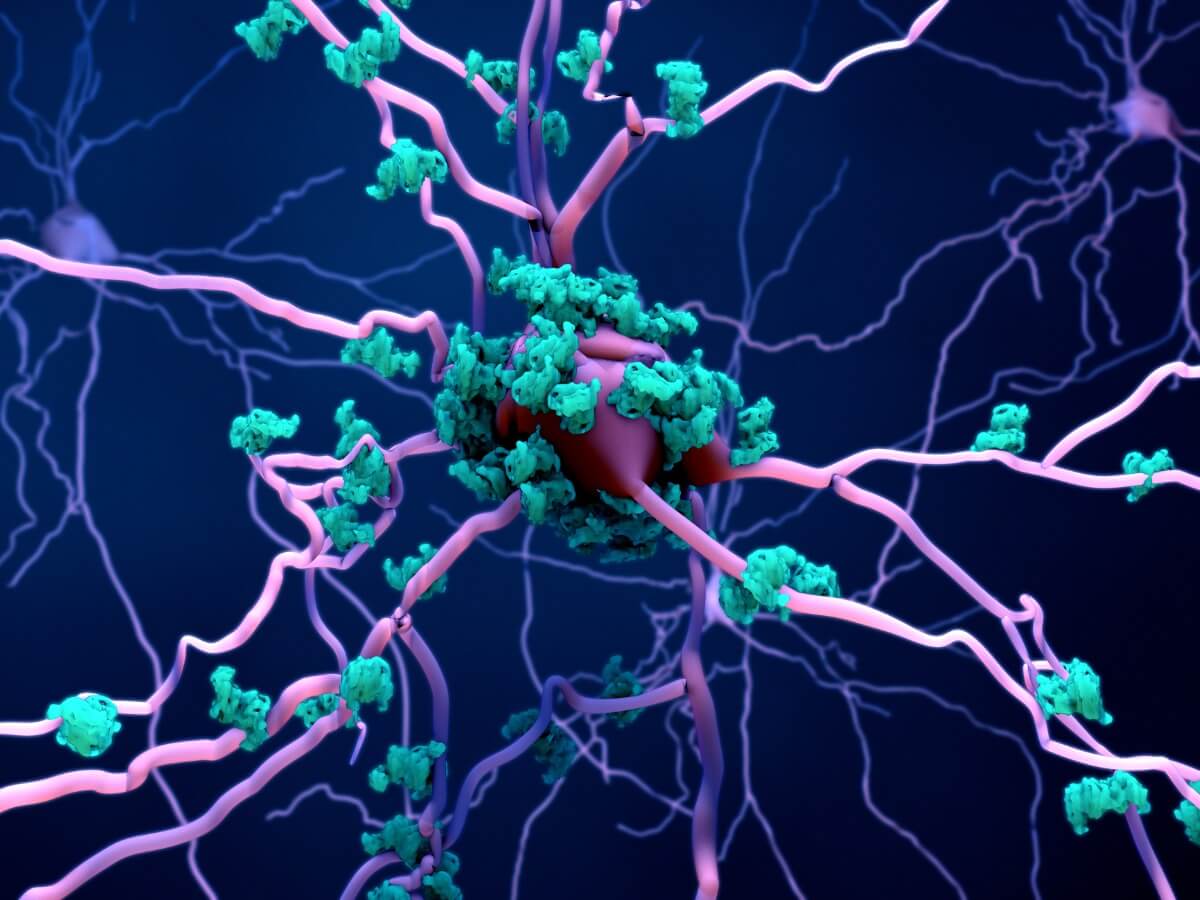 Una neurona dañada por la deposición de amiloides.